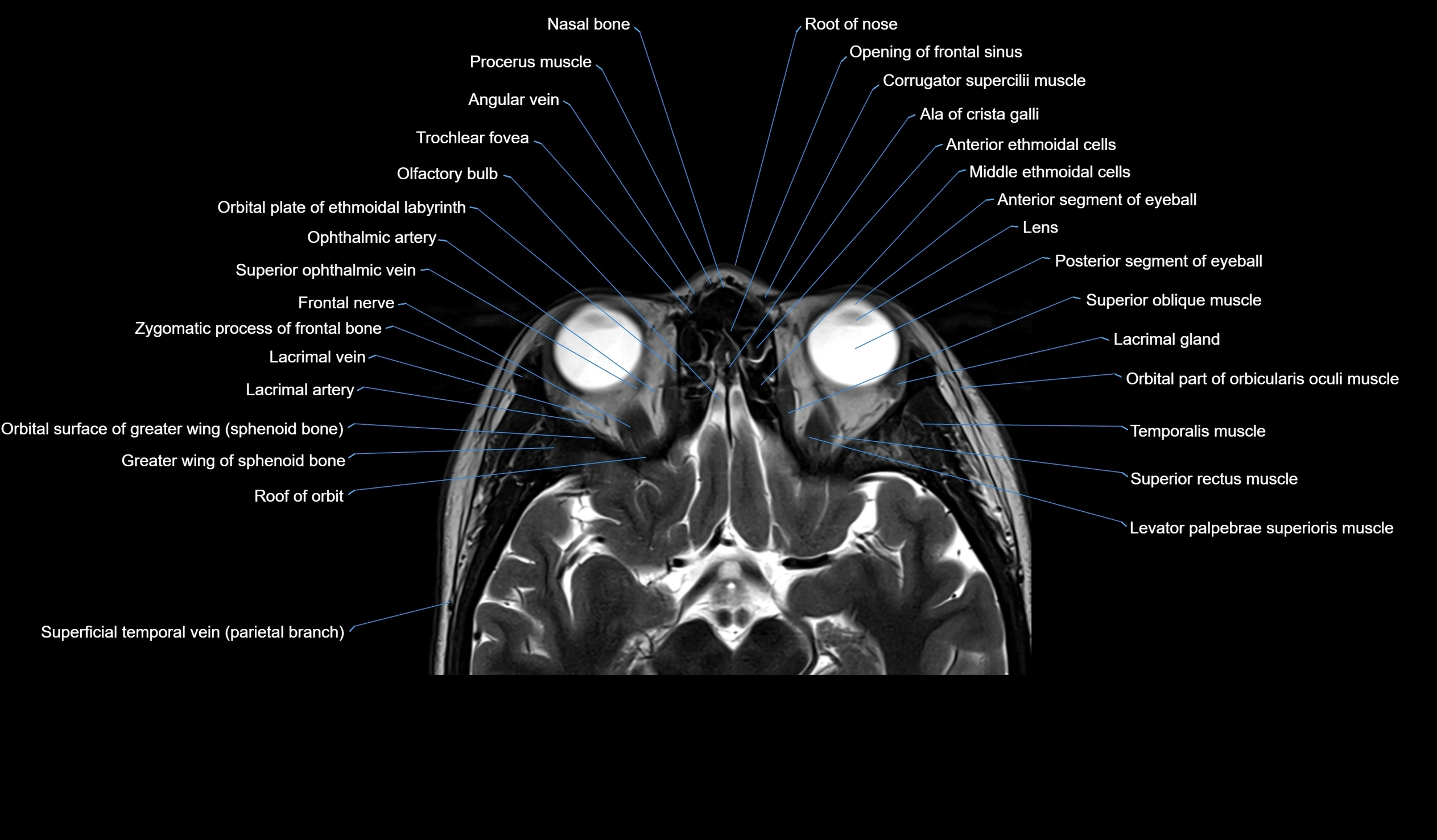 MRI face & paranasal sinuses(PNS) labelled  axial  cross sectional anatomy 3T radiology  image -00024.webp